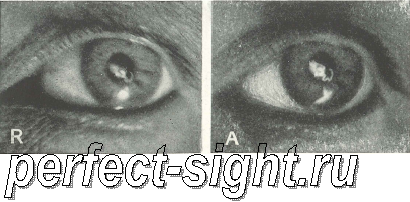 лечение несовершенного зрения без помощи очков