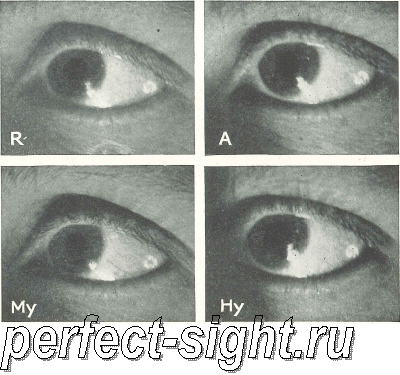 лечение несовершенного зрения без помощи очков